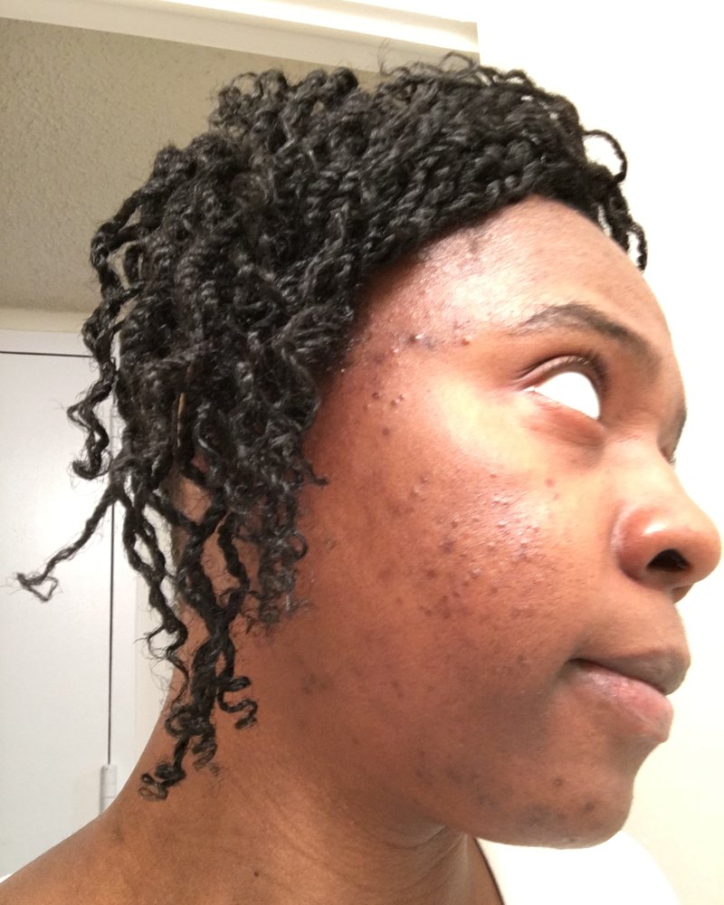 Nadege in 2019 during her skin journey, with breakouts and dark marks on her cheek
