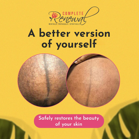 Clinical Grade Scar Fading Butter with Rosehip Oil